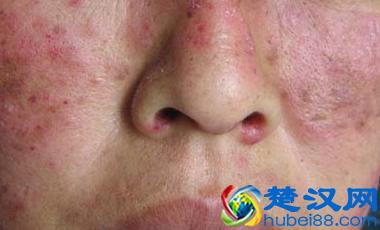 请注意红斑狼疮的早期症状，及时治疗