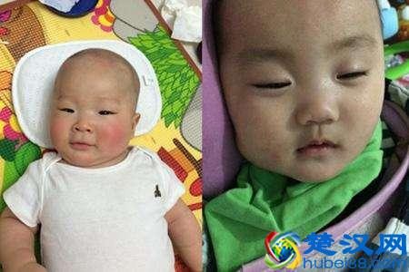 水痘初期症状有哪些 这几种症状要知道