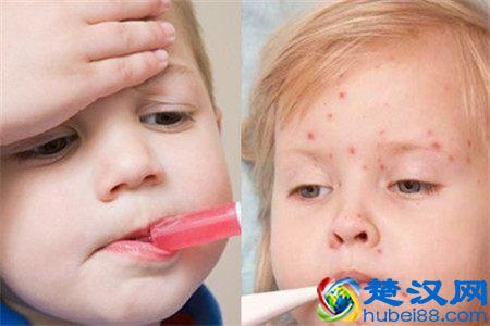 水痘初期症状有哪些 这几种症状要知道