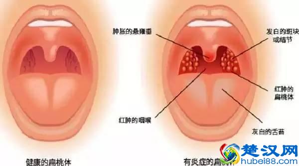 咽喉不舒服，干痒咳嗽，有下面这些症状的，不是咽炎，可能是它