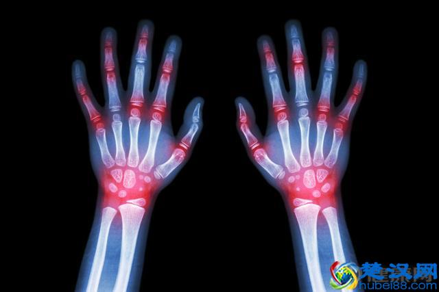 全球痛风患者达1.2亿！有没有痛风，6个症状一对照便知