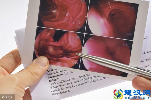 做胃镜时是选择无痛胃镜还是普通胃镜，听听消化科医生的建议！