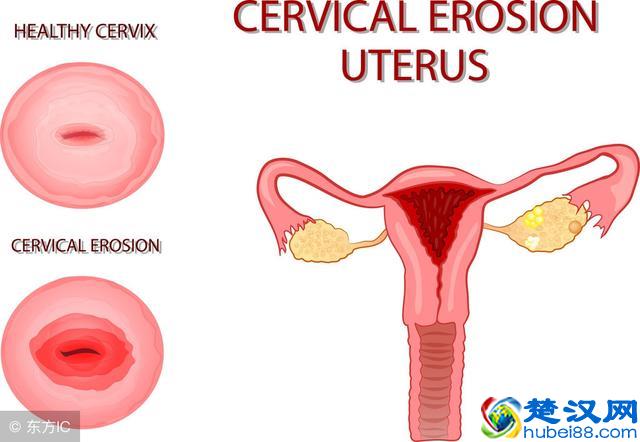 女性们感染宫颈糜烂后会有哪些症状表现出来