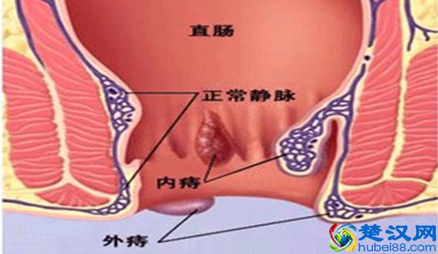 痔疮的最佳防治方法，一般人我不告诉他（建议收藏）