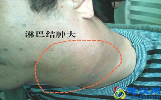 淋巴癌的早期症状有哪些?这样做可有效预防