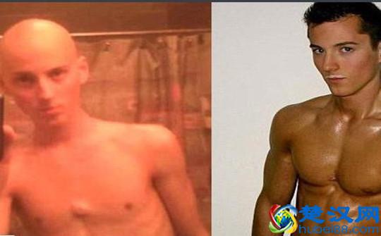 淋巴癌的早期症状有哪些?这样做可有效预防