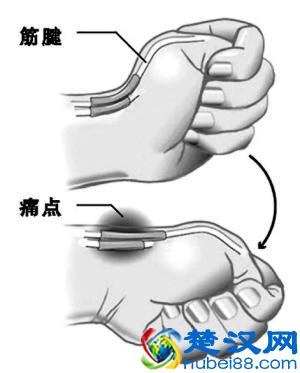 腱鞘炎最佳治疗方法以及日常护理