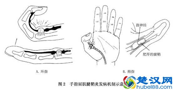 腱鞘炎最佳治疗方法以及日常护理