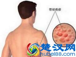 带状疱疹会传染人吗？导致带状疱疹发作的原因是什么？