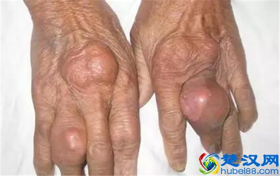 痛风吃什么药止痛最快？2多+1秘方，降尿酸止痛，1周见效