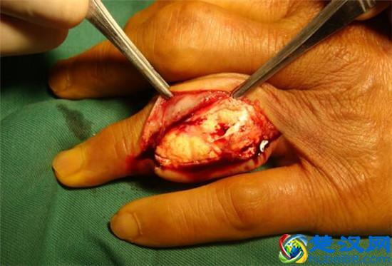 痛风吃什么药止痛最快？2多+1秘方，降尿酸止痛，1周见效