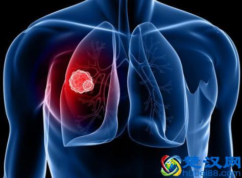 查出肺癌晚期到底能活多久？且听专家解析肺癌晚期的一些情况！