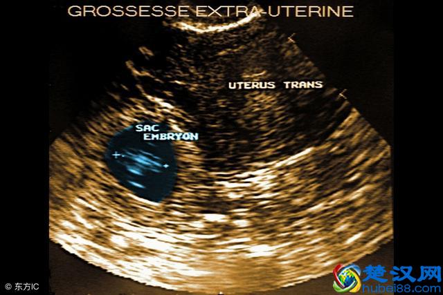 怀孕几周能发现是宫外孕？早期症状表现有几点