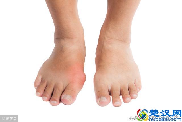 痛风患者不能吃什么？记住这4点，痛风不轻易“上门”