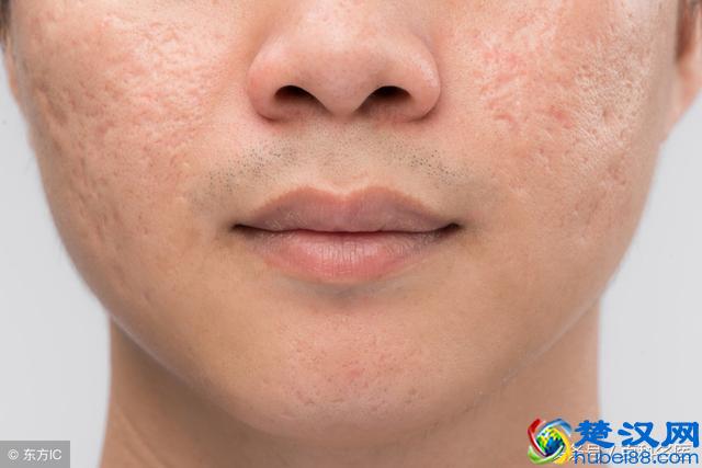 油性皮肤如何改善？皮肤科医生有4个建议！