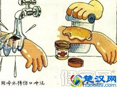 父亲看电视女儿被烫伤 教你一分钟处理开水烫伤