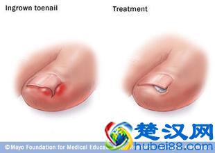 脚趾甲长到肉里面真疼，4种方法教你如何处理嵌甲