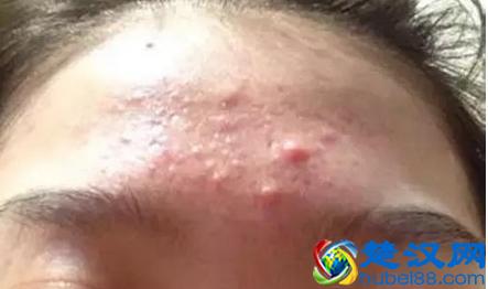 脸上老是爆粉刺怎么办?如何预防粉刺的反复出现