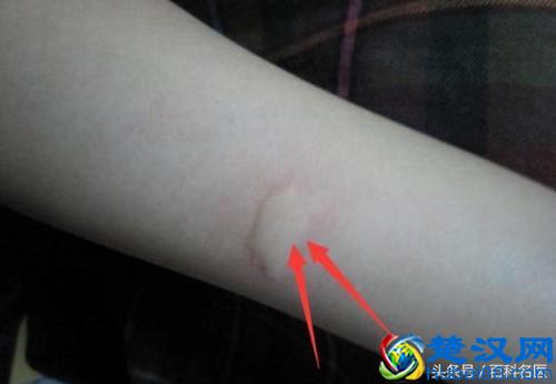 蚊子喜欢叮咬什么血型的人？谁是蚊子的“美味大餐”？这5类人最危险