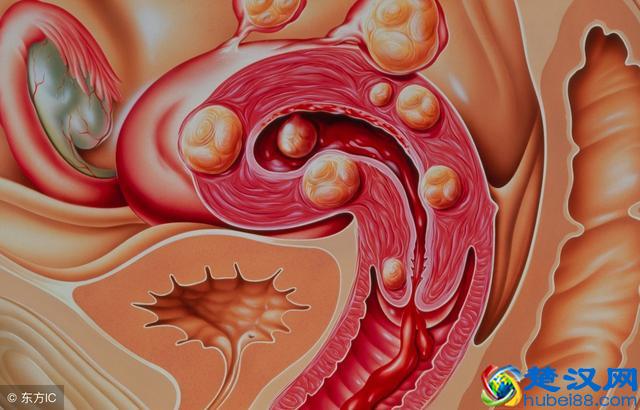 患上子宫肌瘤有什么症状？哪些子宫肌瘤需要手术切除？
