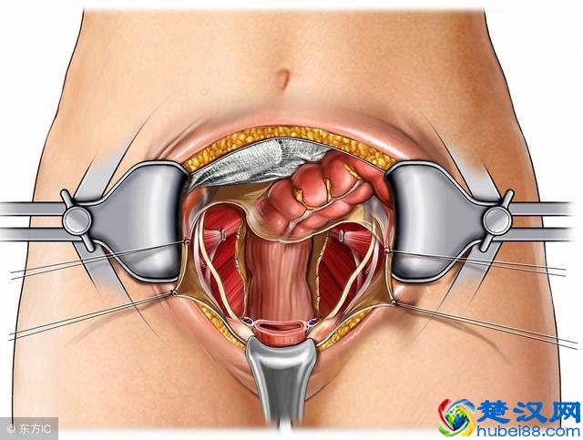患上子宫肌瘤有什么症状？哪些子宫肌瘤需要手术切除？