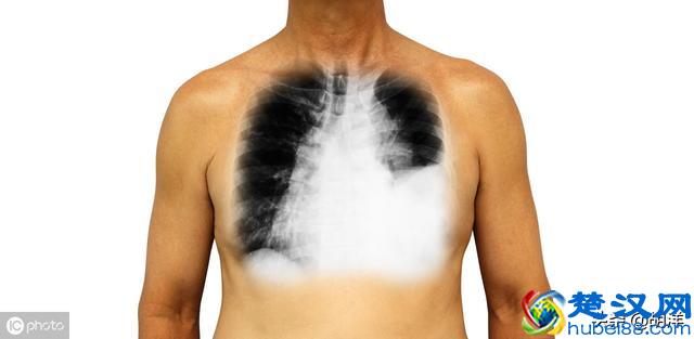 什么样的症状提示肺癌，医生列出7点，每一点都可能是肺癌征兆
