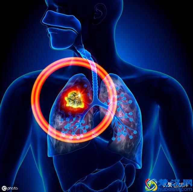 什么样的症状提示肺癌，医生列出7点，每一点都可能是肺癌征兆