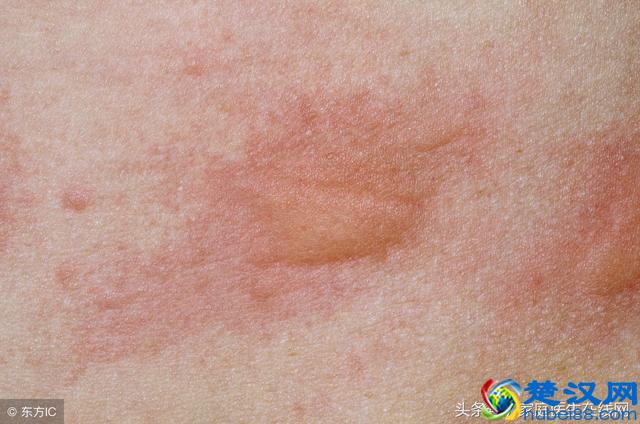 荨麻疹是由什么引起的？这4个“祸首”，哪个都别小看