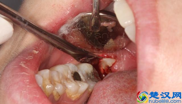 拔牙后24小时以后，能正常吃东西吗？