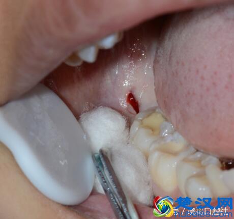 拔牙后24小时以后，能正常吃东西吗？