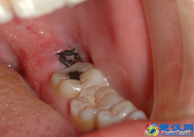 拔牙后24小时以后，能正常吃东西吗？