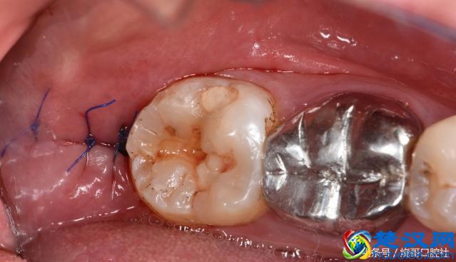 拔牙后24小时以后，能正常吃东西吗？