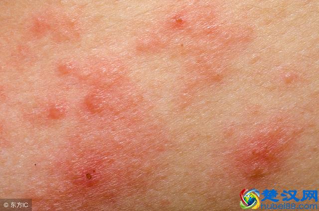 湿疹究竟是什么呢？湿疹的临床分类