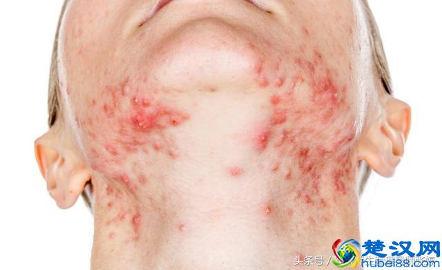 痤疮是由什么引起的？一招教你消除痤疮面部油腻