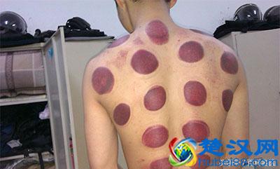 别随便拔罐，拔罐也是有坏处的！