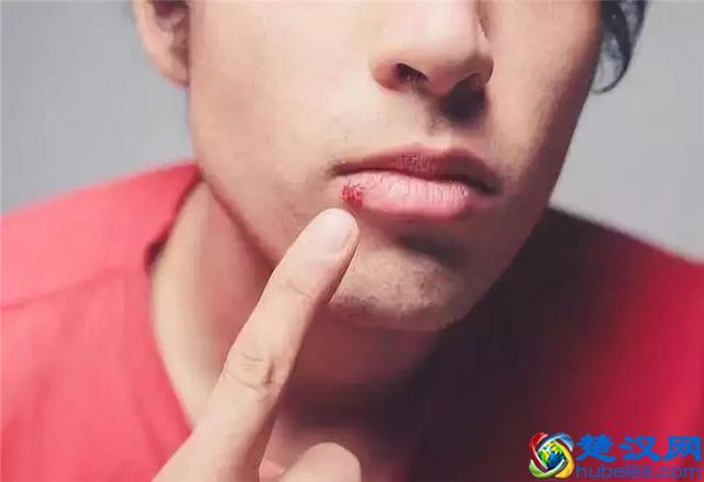 为啥到了秋冬季嘴角总溃烂，真的是上火了吗？听听教授怎么说