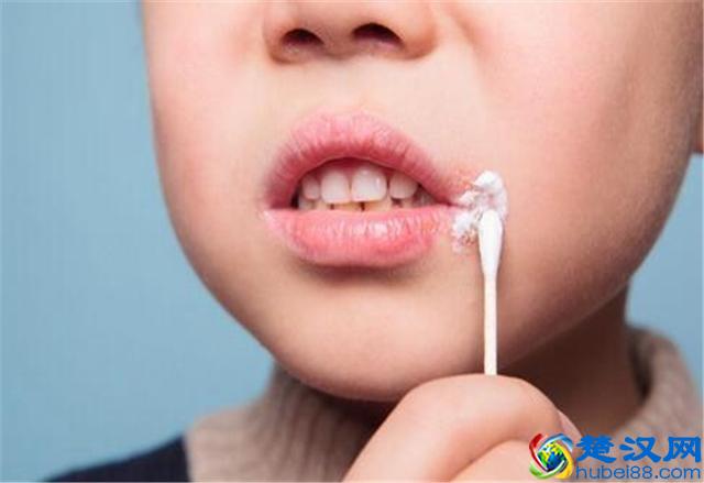 为啥到了秋冬季嘴角总溃烂，真的是上火了吗？听听教授怎么说