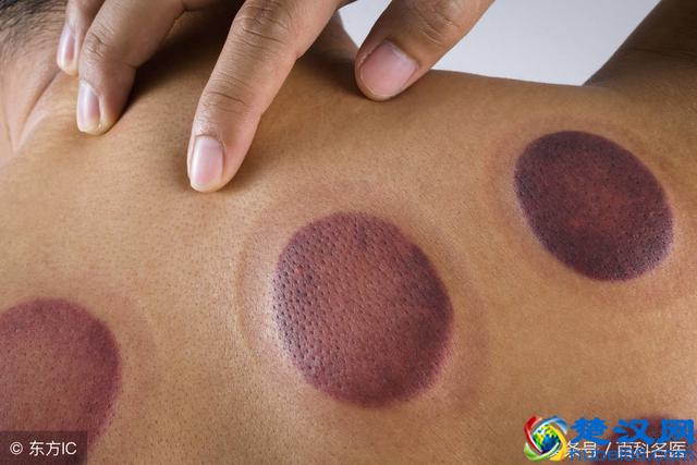 拔罐对身体有哪些好处？拔罐后的水珠和颜色变化代表什么？