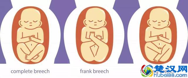 彩超单上的LOA是什么意思？最适合顺产的胎位是哪个？