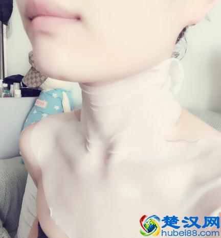 脖子上有草莓印怎么快速消除 消除草莓印的最快方法