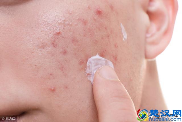 祛痘印、痘坑，药膏要比护肤品有效的多