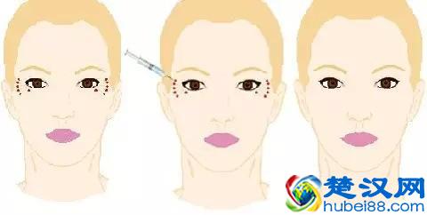 女人！眼角纹的这些事，你肯定不知道