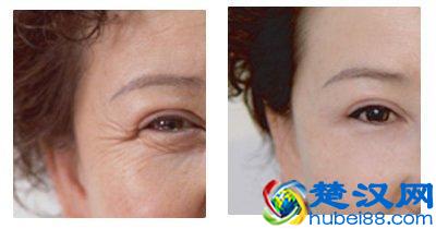 女人！眼角纹的这些事，你肯定不知道