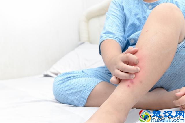 被臭虫咬伤怎么办？它可比蚊子厉害多了！