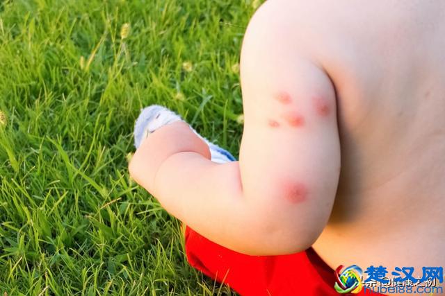 被臭虫咬伤怎么办？它可比蚊子厉害多了！