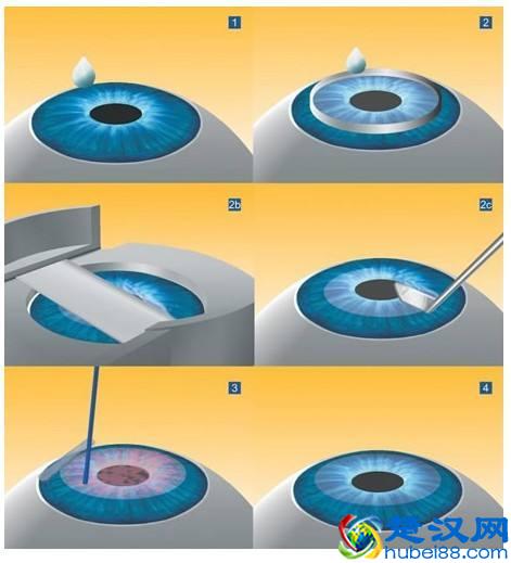 近视了怎么办？这里有3种提高裸眼视力的科学方法