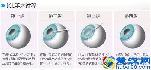近视了怎么办？这里有3种提高裸眼视力的科学方法