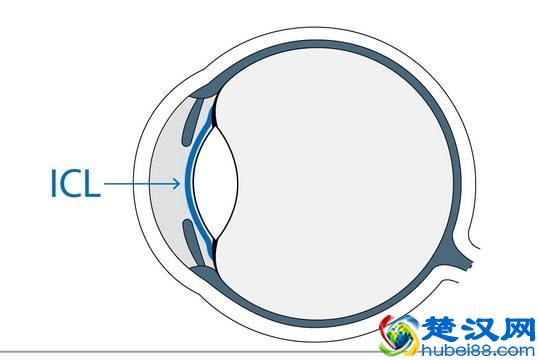 近视了怎么办？这里有3种提高裸眼视力的科学方法