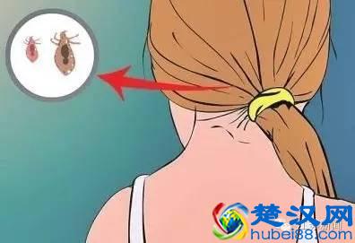 6岁孙女头发长虱子，外婆竟然用敌敌畏给她洗头，怕效果不好还用毛巾包上