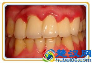 牙周炎能治好吗？得了牙周炎怎么办？